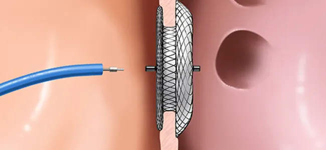Atriyal Septum Defekti ve Patent Foramen Ovale (PFO) Kapatılması
